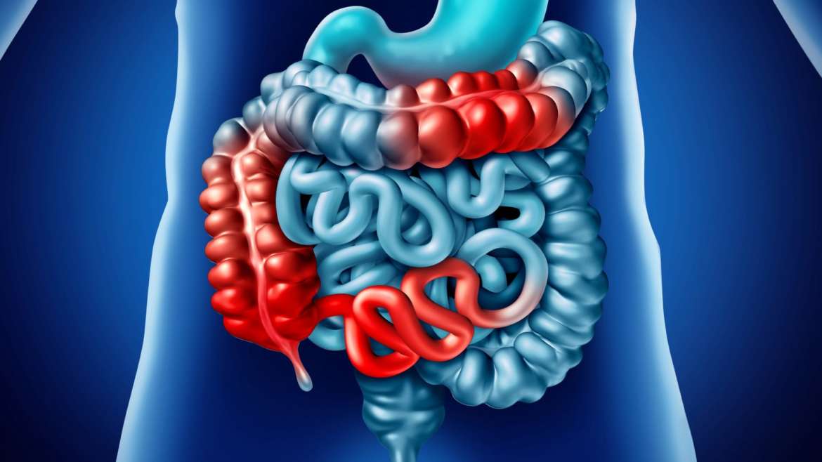 Image of inflammation in the GI tract associated with Crohn's disease.